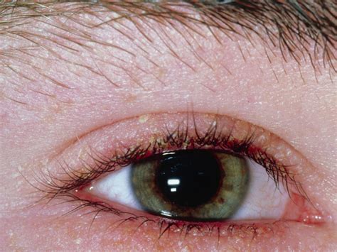 Blepharitis | Eye Conditions | Eyecare | Auckland