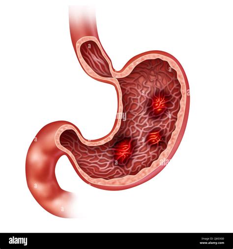 Stomach Ulcer Hi Res Stock Photography And Images Alamy