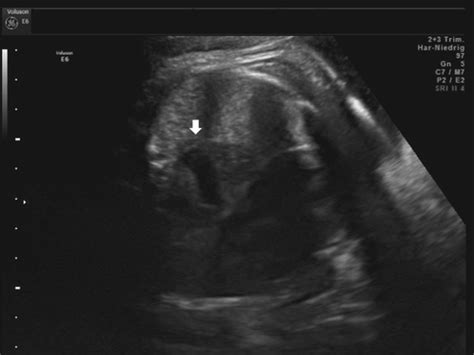 Charge Syndrome In A Fetus With A Large Paraesophageal Hernia Presenting Prenatally As