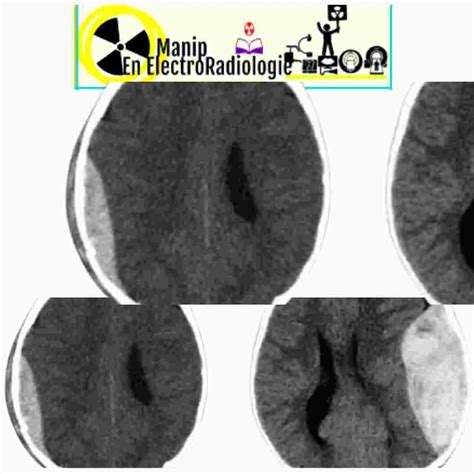 Tdm Cerebrale Scannr Cerebral