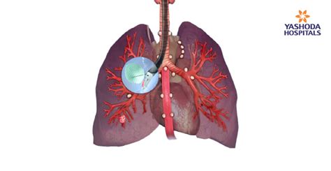 Ebus Tbna For The Diagnosis Of Mediastinal Lymphadenopathy