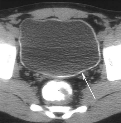 Schistosomiasis An Axial Non Contrast Ct Imaged Through The Pelvis