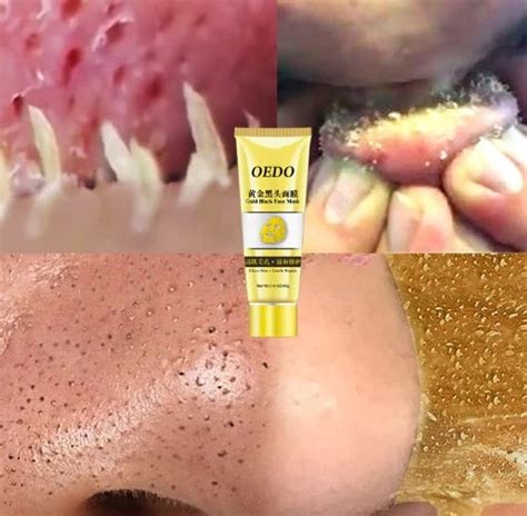 Oedo Gold Remove Blackhead Mask Shrink Pore Improve Rough Skin Acne Sh