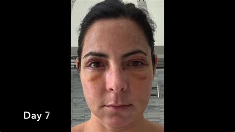 Daily Healing Progress Fat Transfer Upper Lower Blepharoplasty