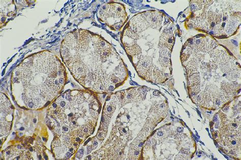 Immunohistochemical Staining Of Calponin On Myoepithelial Cells Pilo