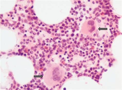 Histological Section From Bone Marrow Trephine Shows Trilineage