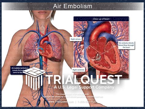 Air Embolism Trialexhibits Inc