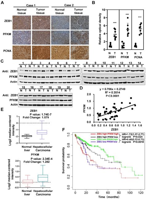 Interrelated High Expression Of Zeb1 And Pfkm Is Correlated With Poor