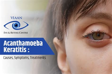 Acanthamoeba Keratitis Causes Symptoms Treatments