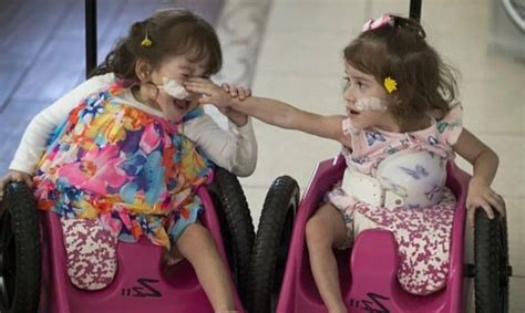 What The Siamese Twins Who Were Able To Be Separated A Few Years Ago Look Like Now Justhappy