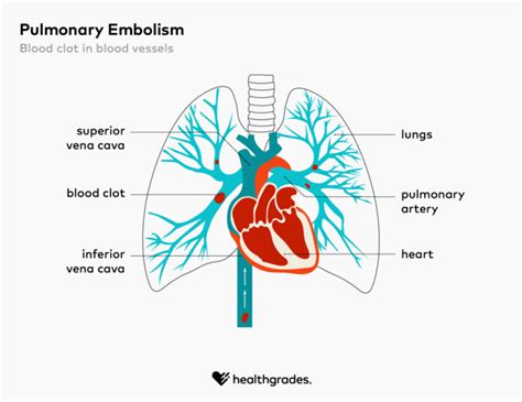 Pulmonary Embolism Symptoms Causes And Treatments