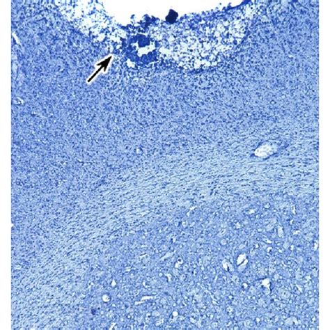 Effects Of P4 And Ru486 On The Growth And Infiltration Of U373 Human