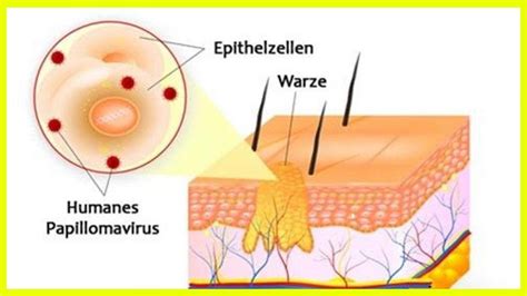 Warum Entstehen Warzen Youtube