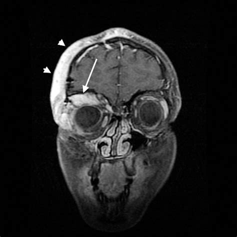 Clinical Images Imaging Manifestations Of Orbital Neurofibromatosis