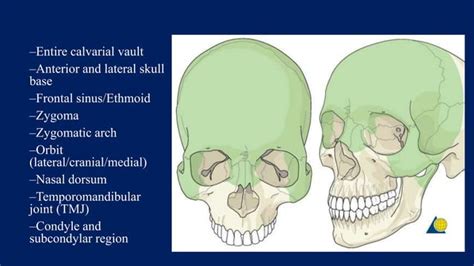 Zygoma Fractures Ppt