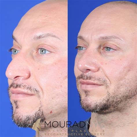 Male Deviated Septum Rhinoplasty Before And After Facial Plastic