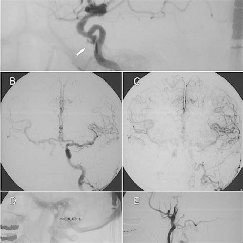 A Right Internal Carotid Artery Angiography Lateral View Showing A