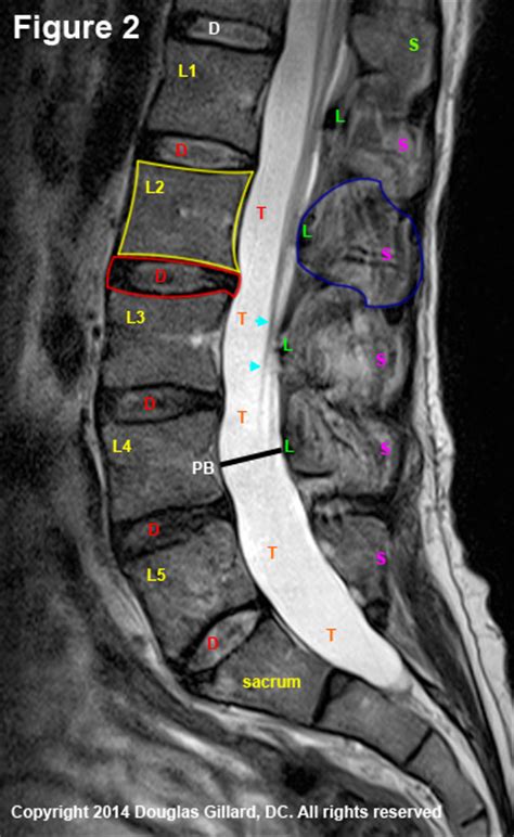 Read Your Mri Basic Education From A World Renowned Spine Expert