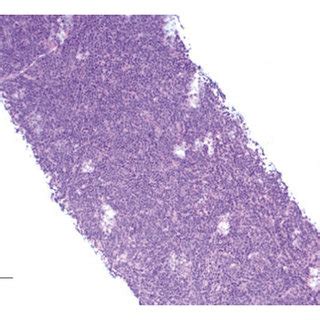 Pathology demonstrating staining consistent with ABC type DLBCL ...