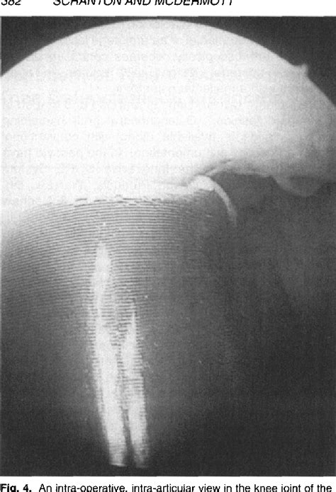 Figure From Treatment Of Type V Osteochondral Lesions Of The Talus