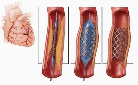 Consultoria De Enfermagem Mendes Hernandez Acidente Vascular