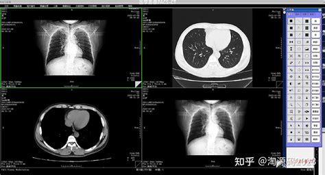 【c 医学影像pacs】ct检查中的三维重建是什么检查？ 知乎