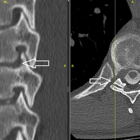 Post Operative Ct Myelogram A Sagittal Ct Reconstruction And B Download Scientific Diagram