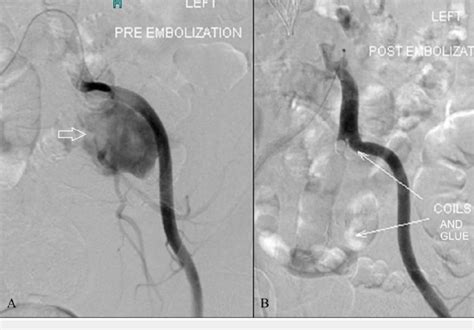 Pre A And Post Embolization B Runs Show The Left Common Iliac