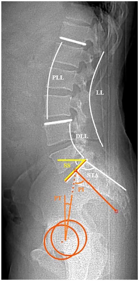 Measurement Of Spinopelvic Parameters Dll Indicates Distal Lumbar