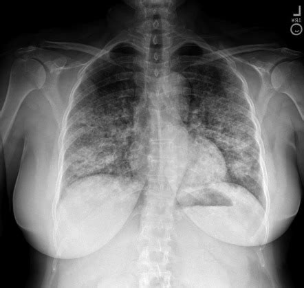 Pulmonary Alveolar Proteinosis Radiology Case Radiopaedia Org