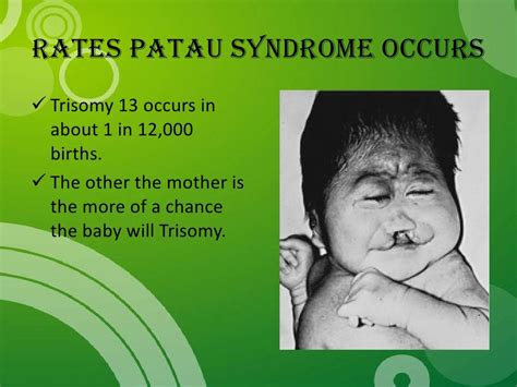 Patau Syndrome