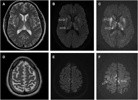 Boala Creutzfeldt Jakob simptome cauze diagnostic și tratament