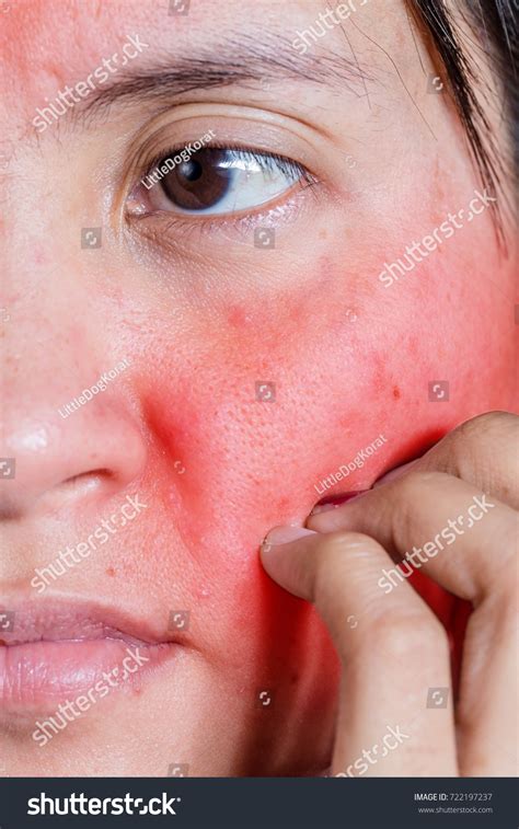 Itchy Skin Rash On Face