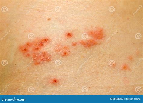 Shingles Rash Stock Image Image Of Health Fungal Herpes 28588363