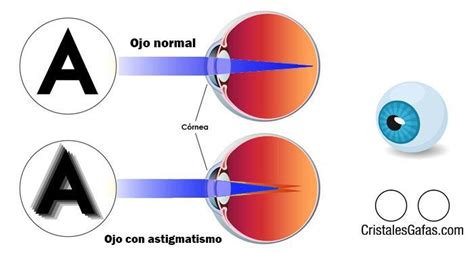 Qué es el astigmatismo cómo saber si lo tengo y cómo corregirlo