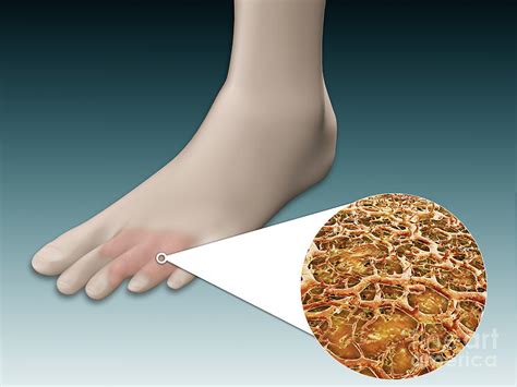 Anatomy Of Foot Fungus With Microscopic Digital Art by Stocktrek Images