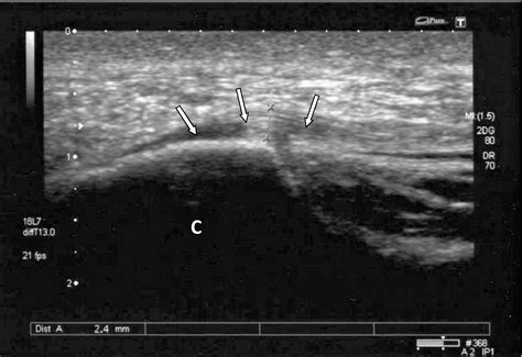 Ultrasound Images Of Plantar Fasciitis Ankle Foot And Orthotic Centre