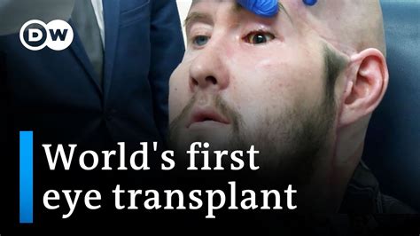 Surgeons Perform World S First Human Eye Transplant DW News The