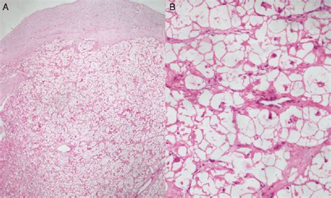 Histological Images A A Low Power View Showing Well Demarcated