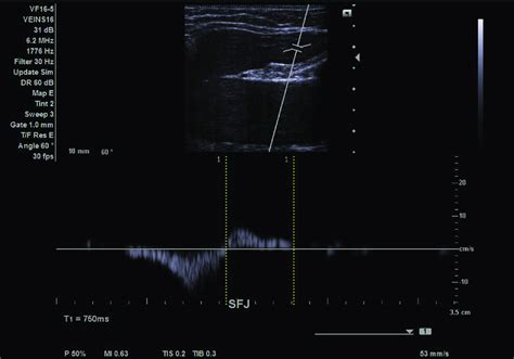 Duplex ultrasound image of anterior accessory great saphenous vein ...