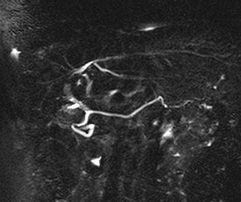 References In Endoscopic Retrograde Pancreatography Clinical