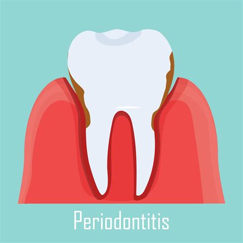 Periodontitis Problem Gum Sick Illustration Of Human Tooth With