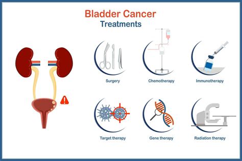 Vector medical illustration in flat style,bladder cancer treatment ...