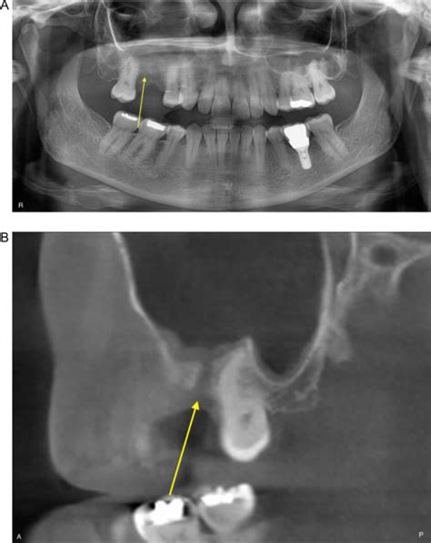 Panoramic Radiography Is Of Limited Value In The Evaluation Of