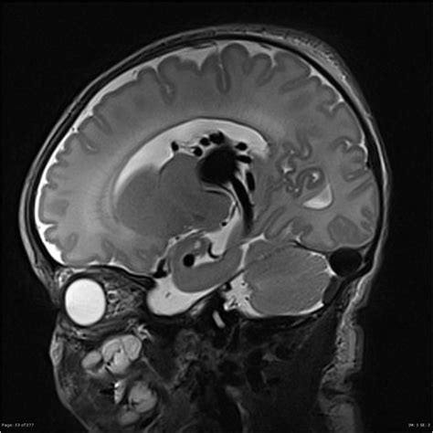 Vein of Galen malformation | Radiology Case | Radiopaedia.org ...