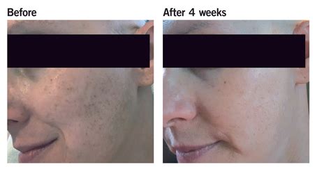 Proven Results Neova® Smartskincare