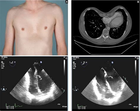 Cardiopulmonary Outcomes After The Nuss Procedure In Pectus Excavatum