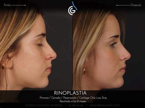 Caso Foto Rinoplastia Drguilarte