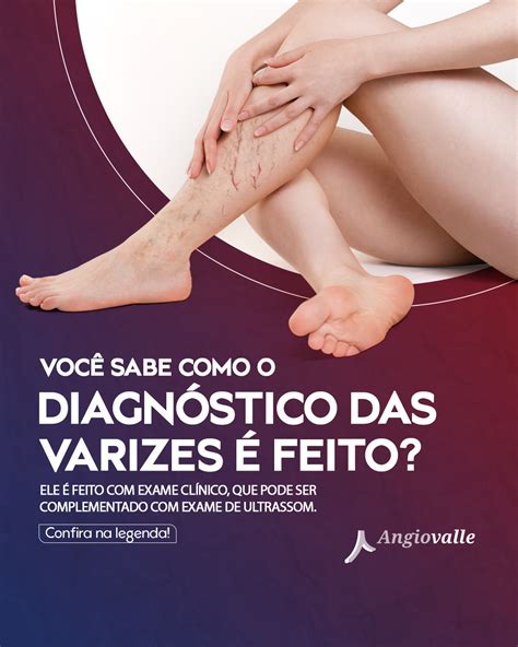 Voc Sabe Como O Diagn Stico Das Varizes Feito Angioviva