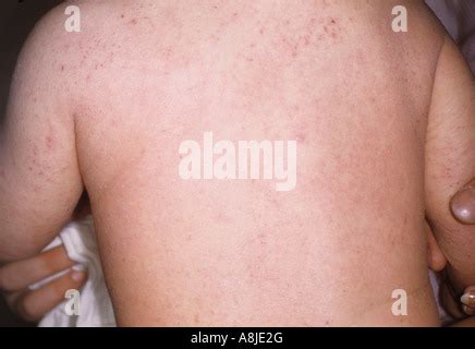 Atopischer Dermatitis Gemeinhin Als Ekzem Ist Eine Chronische